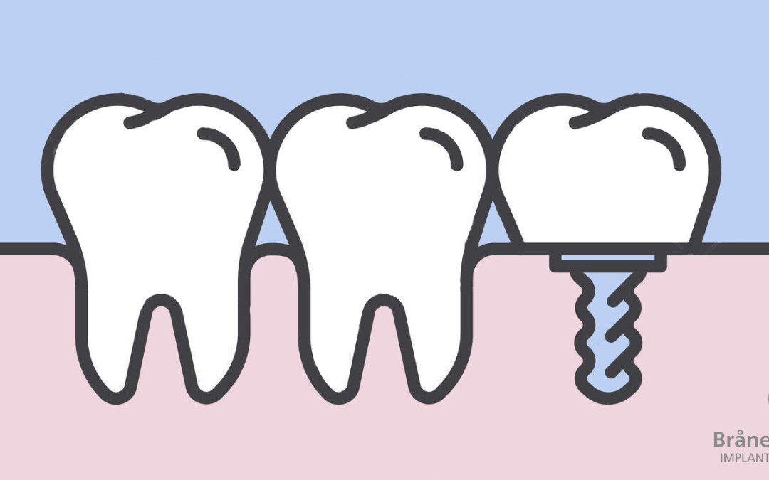 Fases colocación de un implante dental.